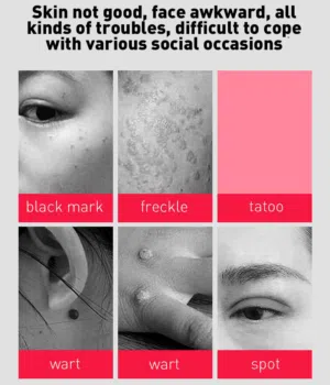 جهاز إزالة شعر بالليزر المنزلي  NEATCELL Laser Pen
