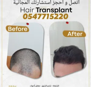 ضمان مدى الحياة راضي او معوض زراعة شعرالراس؛ اللحية؛ الحواجب و الشوارب بالشارقة: المركز الدولي الطبي