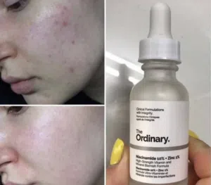 The Ordinary Niacinamide 10% + Zinc 1% أصلي لعناية البشرة