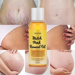 Stretch Marks Remover