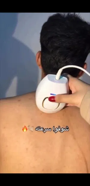 *الوكاله مضمون*   *جهاز ليزر IPL   جهاز ليزر لإزالة الشعر بشكل دائم.. ماركه إيطالية وتخلصون من الشعر