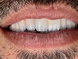 مختبر أسنان رقمي متطور – زيركون، E.max، فينير، تيجان وجسور بأعلى جودة