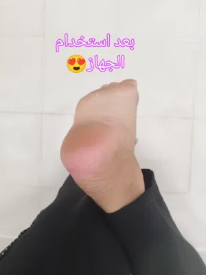 جهاز إزاله الجلد الميت وتقشير القدم   جهاز تقشير كعب القدم لازالة الجلد  الميت .  يعمل على تنع