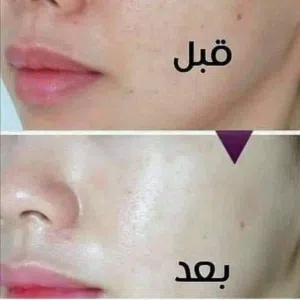 معالج الكلف والنمش والتصبغات واثار الحبوب