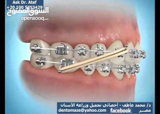 مطاط تقويم الأسنان رقم 8 135649698 السوق المفتوح