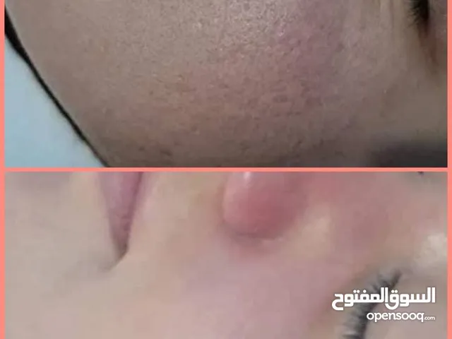 عرض علاج التشققات ومعالجة مشاكل بشرة الوجه والجسم