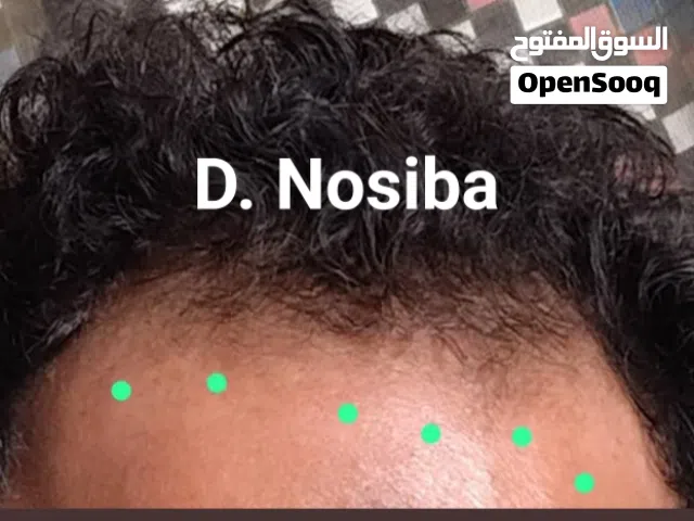 مجموعه انبات الصلعه والجلحات