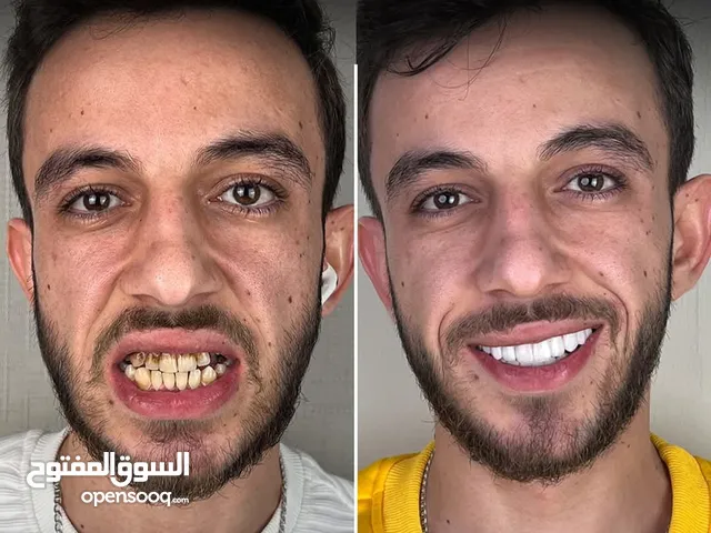 ابتسامه هوليود (فينير )