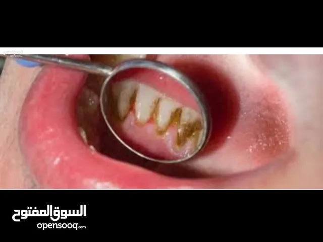 القلع _تنظيف أسنان _حشوات معدنيه _حشوات ضوئيه _طقم جزئي