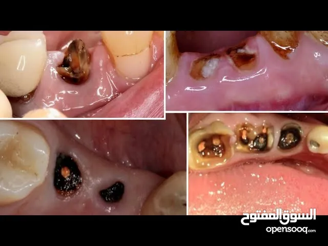 خطورة بقايا جذور الأسنان التالفة
