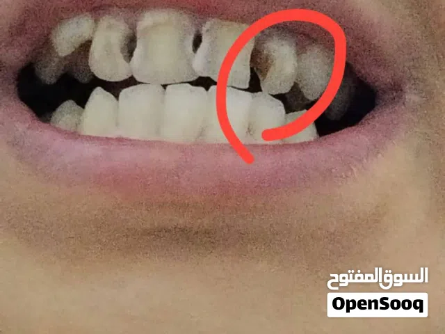 السلام عليكم ، حشوة للاسنان الامامية من طبيب اسنان في جامعة المعقل