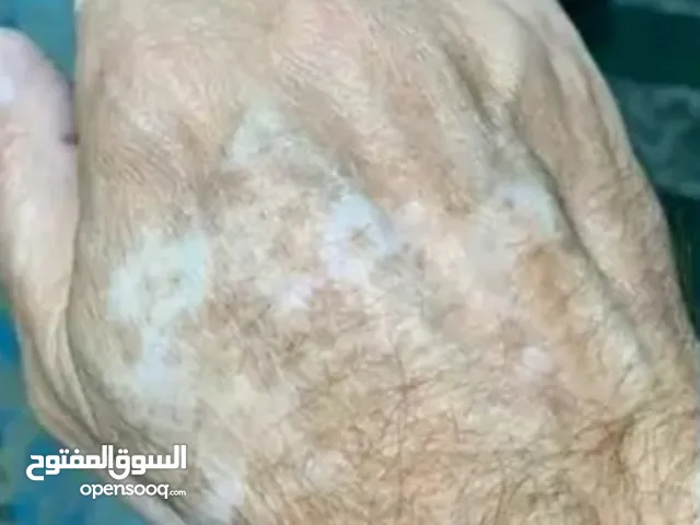 كل ما يخص البهاق