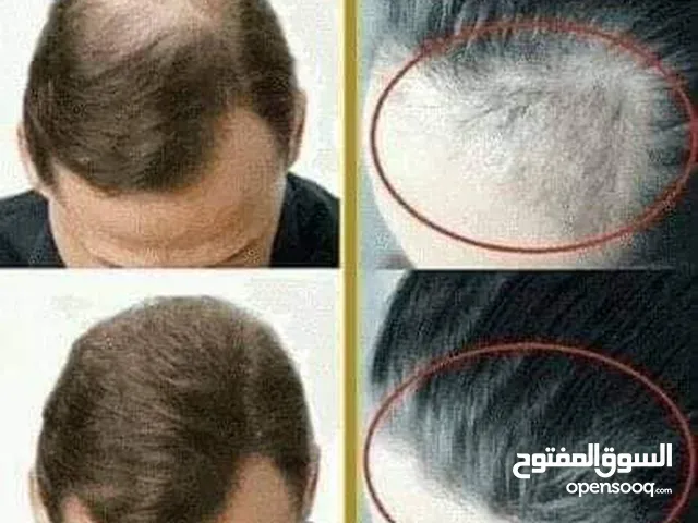 هام للرجال والنساء ودع تساقط الشعر الفراغات الصلع الوراثي بديل زراعة الشعر