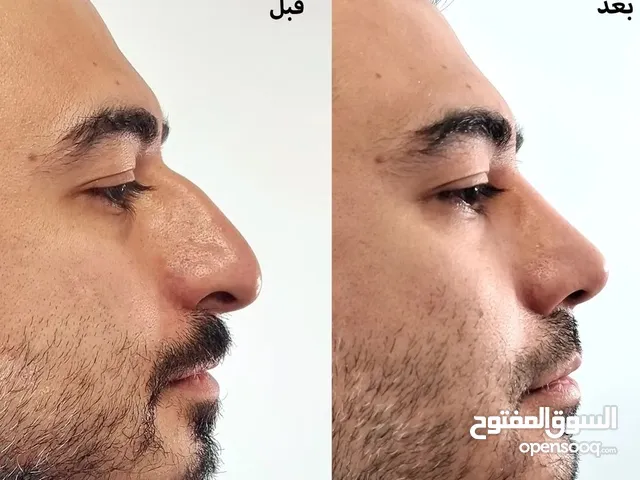 تجميل الأنف في إيران/طهران مع أفضل طبيب