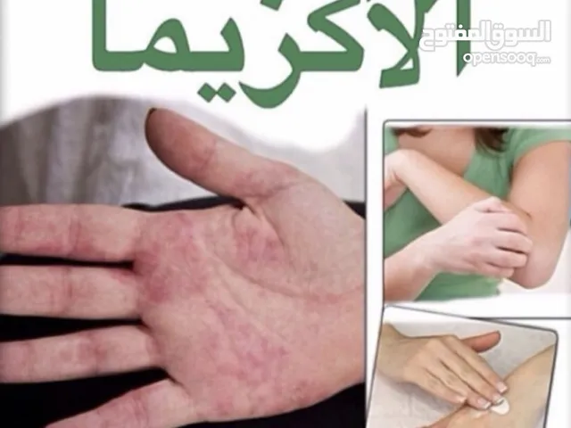 خلطة للتحلص من الاكزيما