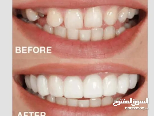 طقم اسنان snapon smile