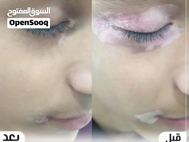 معا لتوحيد البهاق