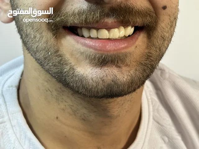تركيبات الأسنان الشفافة زيركون ابتسامة المشاهير