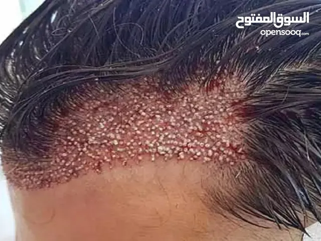 زراعة الشعر و الحواجب