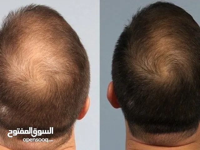 بلازما للشعر+حجامة طبية