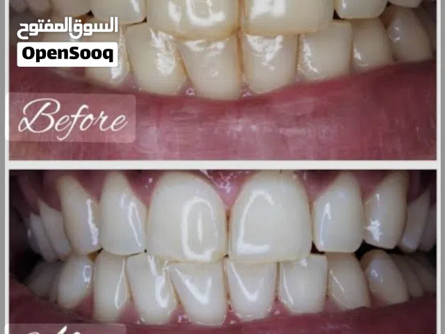 تبيض اسنان منزلي  خدمه منزليه