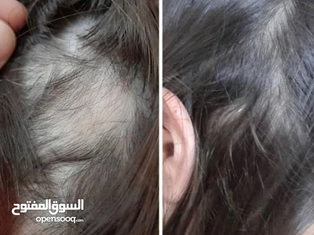هام للرجال والنساء ودع تساقط الشعر الفراغات الصلع الوراثي بديل زراعة الشعر خلال 15 يوم شعر كثيف