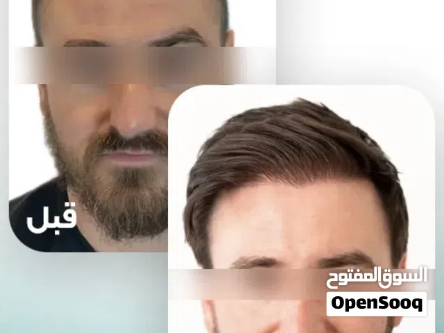 زراعة الشعر