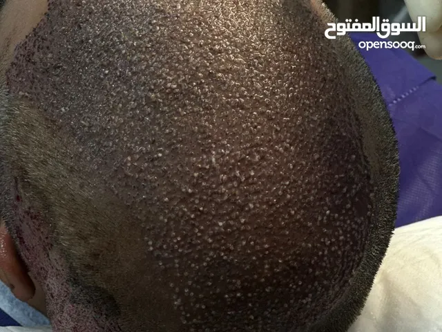 زراعه الشعر فی الاهواز