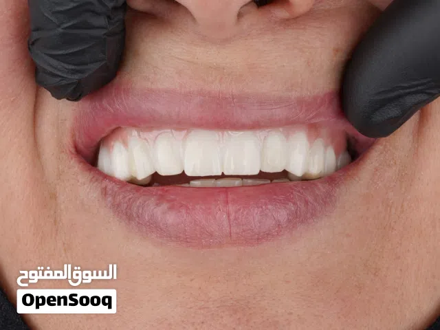 زراعة الاسنان في عيادة توباز