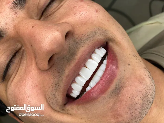 زراعة شعر تجميل انف ابتسامة هولیوود قشور جذر فنیر اسنان شفط فلرشفایف زراعة اسنان