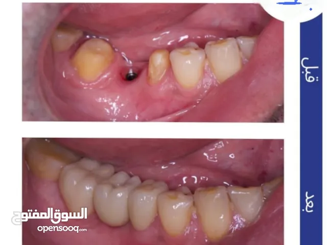 عيادة أسنان متكاملة زراعة - تقويم - تبييض أسعار تنافسية + صور نتائج حقيقية قبل وبعد المعالجة