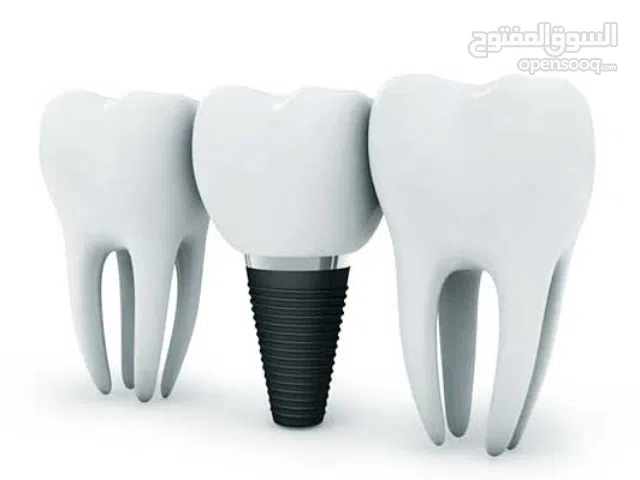 زراعة أسنان مجانية