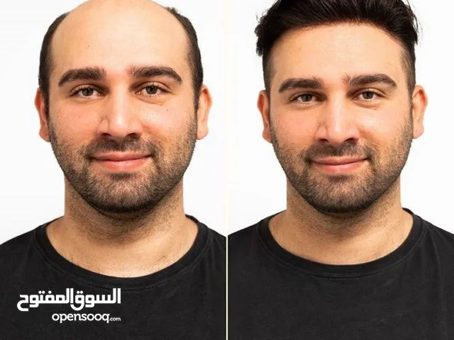 زراعة الشعر بأعلى جودة ونتائج مضمونة!