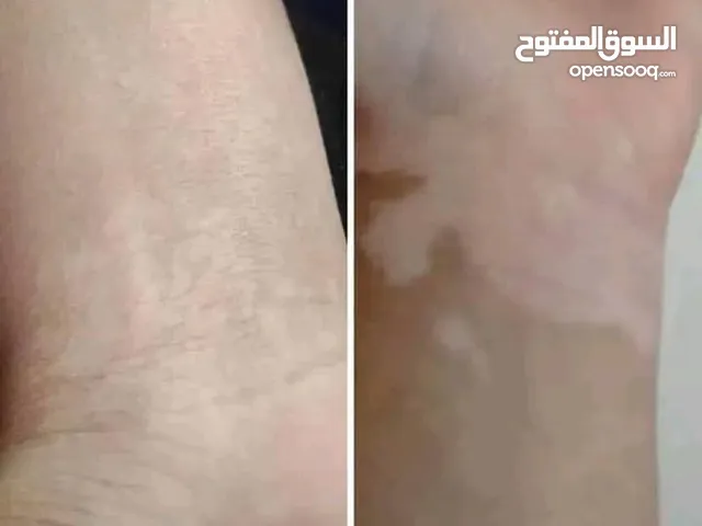 كريمات البهاق