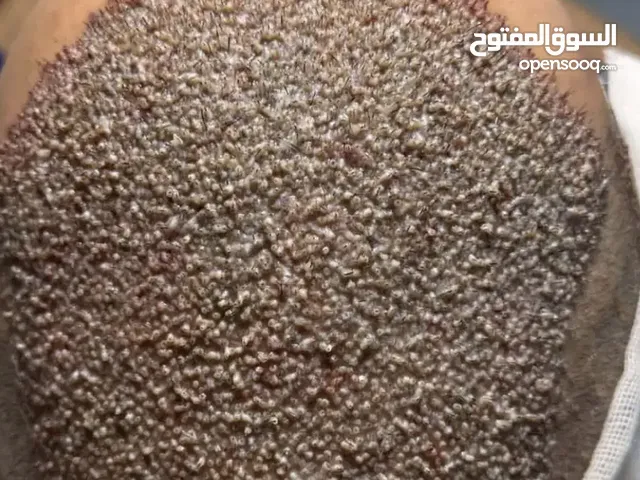 “زراعة الشعر الآن في الأهواز