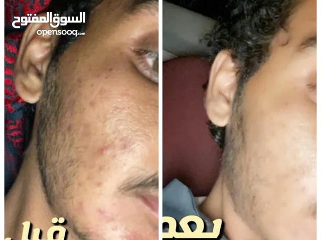مجموعة العناية بالبشرة والتخلص من الحبوب والاثار والتصبغات والحفر منتجاتنا طبيعية 100% آمنة للجميع