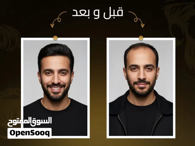 خبراء الشعر البديل وعلاج الصلع في حلب