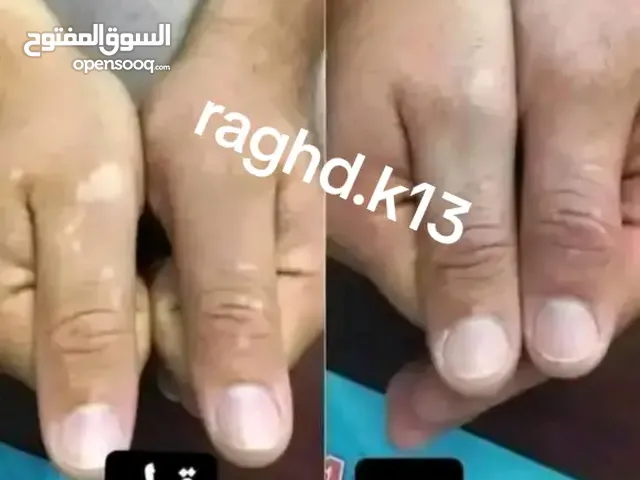 البهاق وطرق علاجيه تساعد بتوحيد لون البشره ومعالجة البهاق