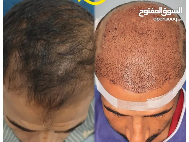 زراعه شعر فی الاهواز سعر مناسب 100%100کافی دزلی صوره من عندک وتاخذ کامل التفاسیر الی زراعه الشعر