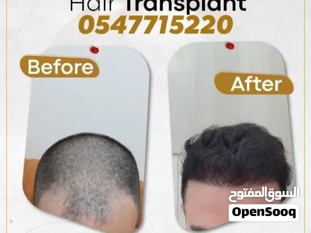 ضمان مدى الحياة راضي او معوض زراعة شعرالراس؛ اللحية؛ الحواجب و الشوارب بالشارقة: المركز الدولي الطبي