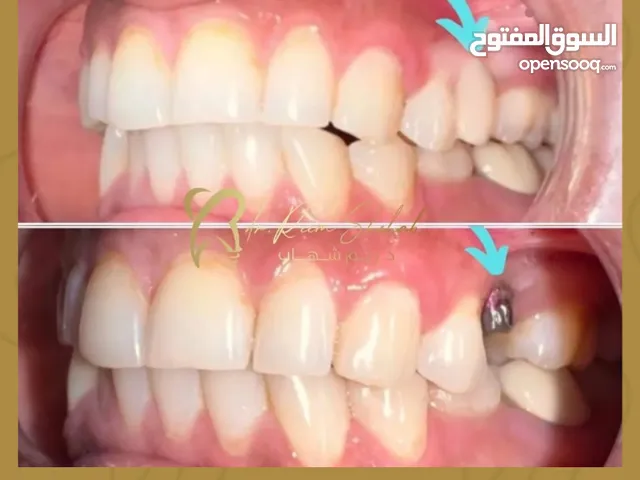 خصومات كبيرة في عمليات زراعة وتجميل الأسنان الان في عيادة الدكتورة ريم شهاب صفوة المهيدب فرع القنفذة