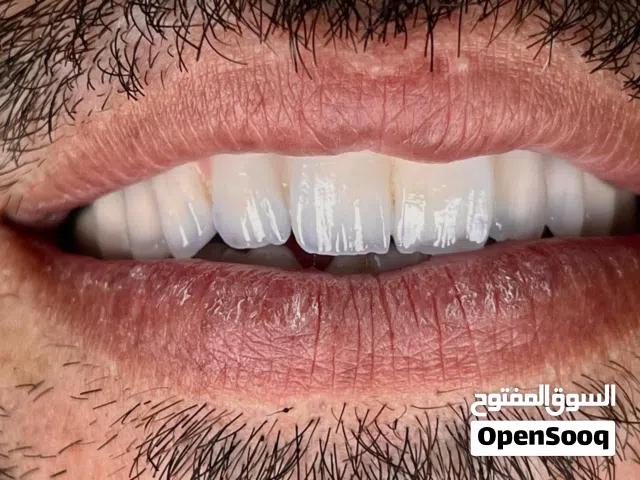 مختبر أسنان رقمي متطور – زيركون، E.max، فينير، تيجان وجسور بأعلى جودة