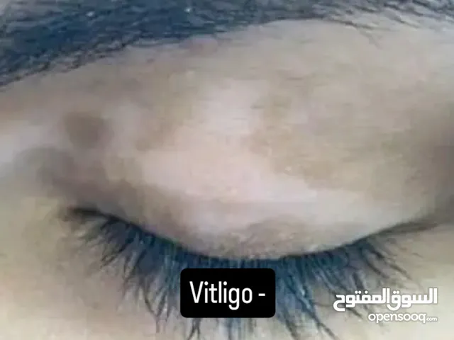 للعلاج حالات البهاق تواصل بالحساب من غير اضرار جانبيه