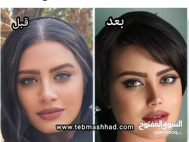 عملیة تجميل الأنف