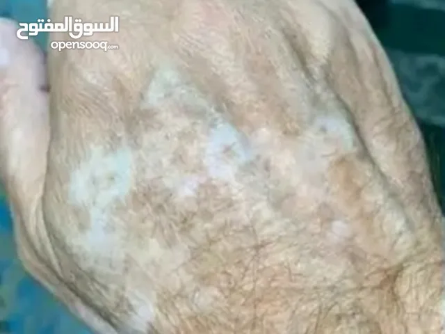 واصل خاص للاستفسار عن علاج البهاق