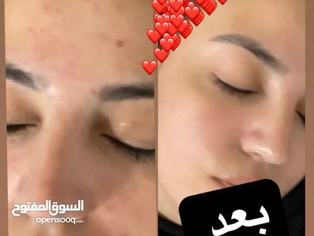 جلسة علاج بشرة