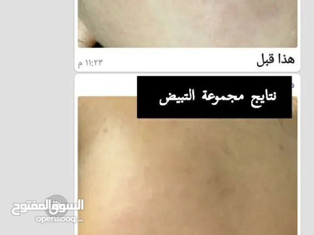 الخلطه الملكيه سنو وايت لتفتيح الوجهه وكامل الجسم من اول اسبوع يظهر الفرق
