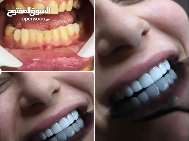 تجمیل أسنان